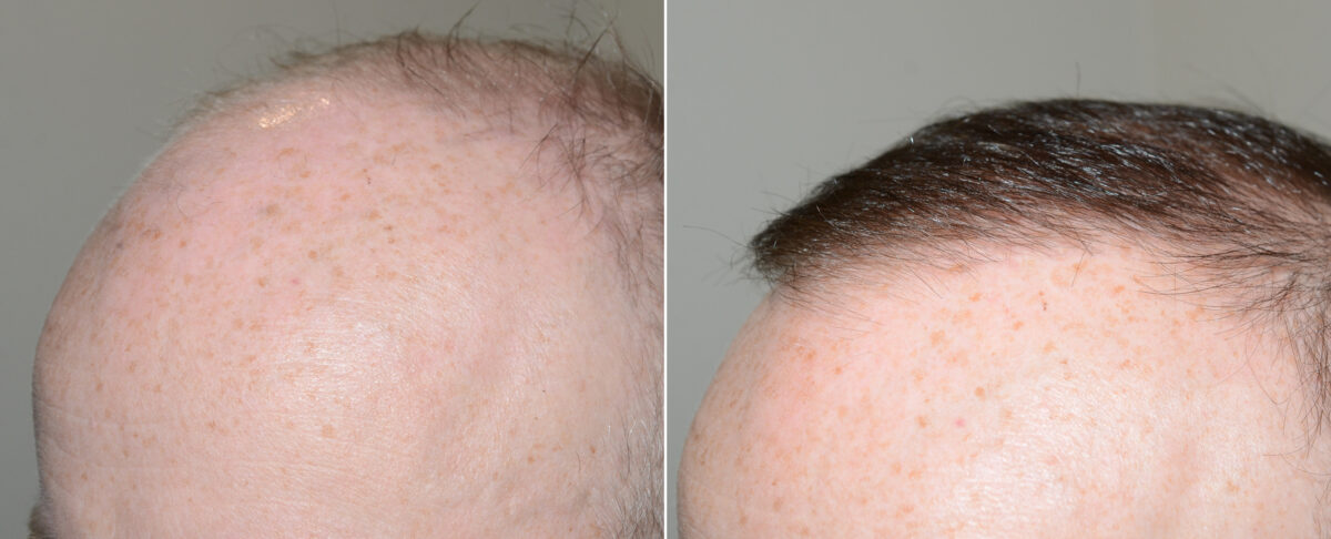 Body Hair Transplant Before and after in Miami, FL, Paciente 110728