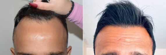 Forehead Reduction Surgery Before and after in Miami, FL, Paciente 121688