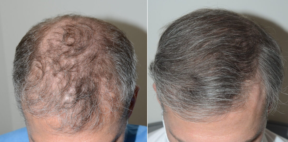 Hair Transplants for Men Before and after in Miami, FL, Paciente 123029