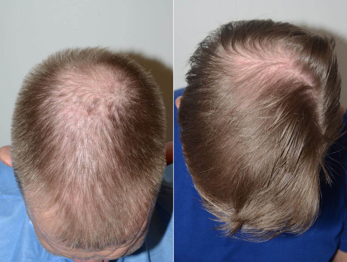 Hair Transplants for Men Before and after in Miami, FL, Paciente 123096