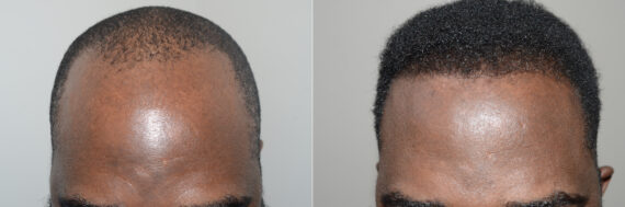 Hair Transplants for Men Before and after in Miami, FL, Paciente 123113