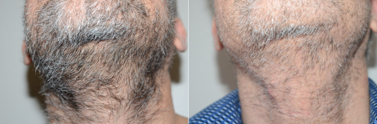 Body Hair Transplant Before and after in Miami, FL, Paciente 123219