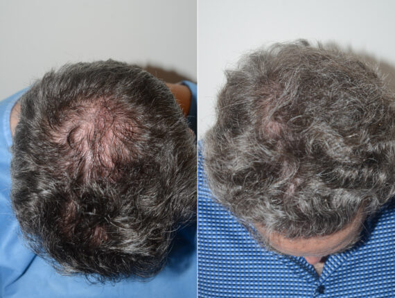 Body Hair Transplant Before and after in Miami, FL, Paciente 123219