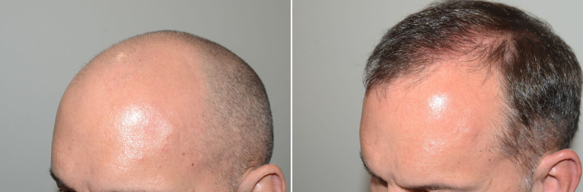 Hair Transplants for Men Before and after in Miami, FL, Paciente 123679