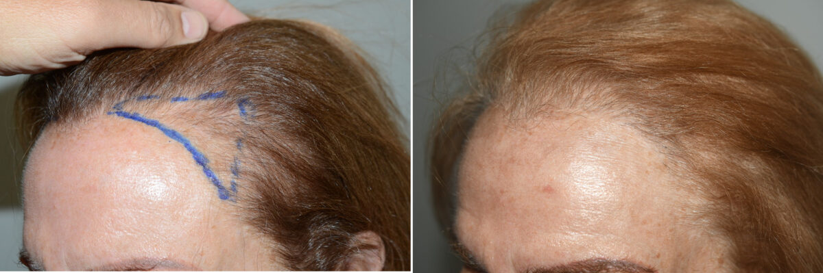 Forehead Reduction Surgery Before and after in , , Paciente 125030
