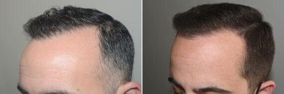 Forehead Reduction Surgery Before and after in Miami, FL, Paciente 125044