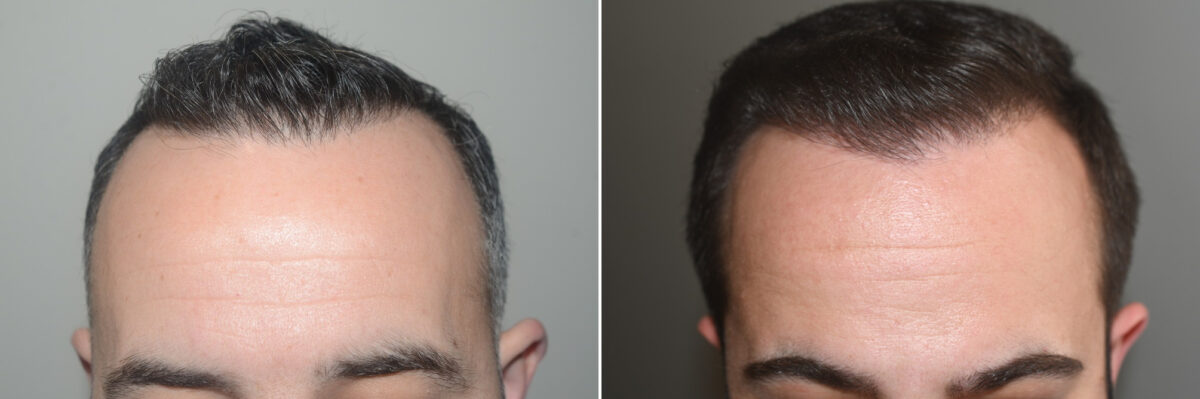 Forehead Reduction Surgery Before and after in Miami, FL, Paciente 125044