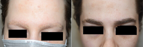 Eyebrow Hair Transplant Before and after in Miami, FL, Paciente 125107