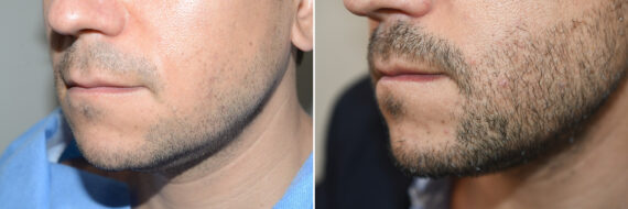 Facial Hair Transplant Before and after in Miami, FL, Paciente 125152