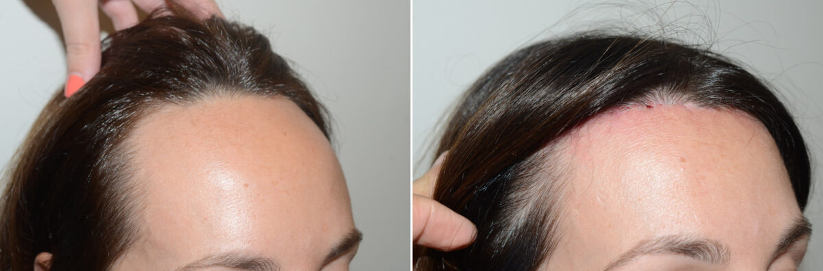 Forehead Reduction Surgery Before and after in Miami, FL, Paciente 125171