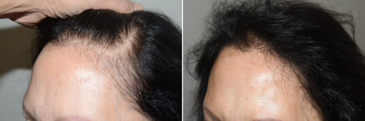 Forehead Reduction Surgery Before and after in Miami, FL, Paciente 125184