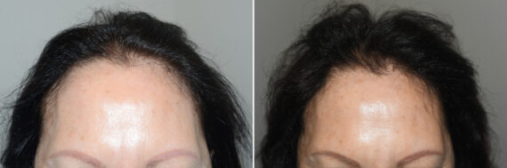 Forehead Reduction Surgery Before and after in Miami, FL, Paciente 125184