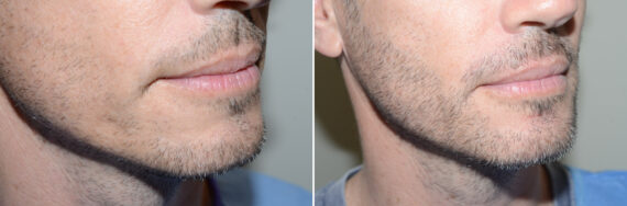 Facial Hair Transplant Before and after in Miami, FL, Paciente 125203
