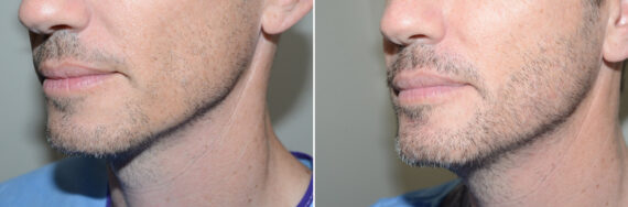 Facial Hair Transplant Before and after in Miami, FL, Paciente 125203