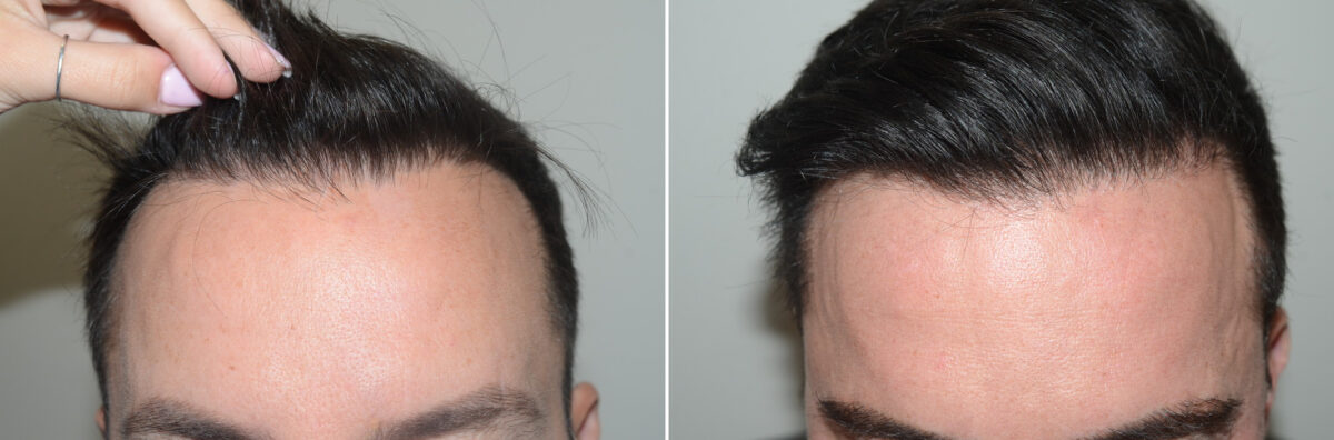 Hair Transplants for Men Before and after in Miami, FL, Paciente 125222