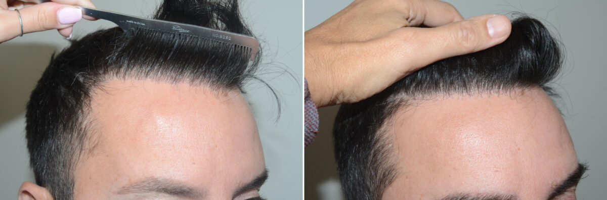 Hair Transplants for Men Before and after in Miami, FL, Paciente 125222
