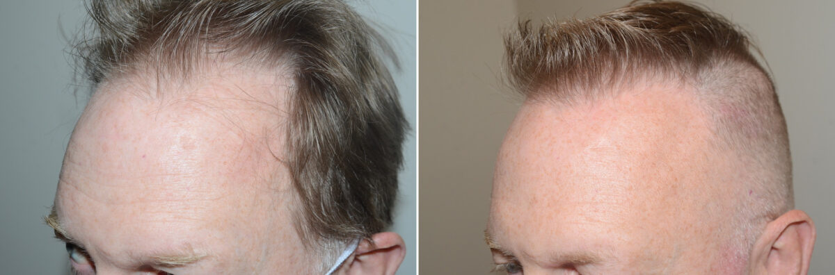 Hair Transplants for Men Before and after in Miami, FL, Paciente 125258