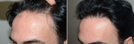 Hair Transplants for Men Before and after in Miami, FL, Paciente 125275