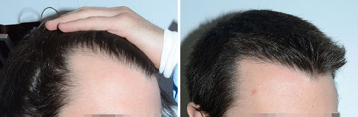 Hair Transplants for Men Before and after in Miami, FL, Paciente 37499