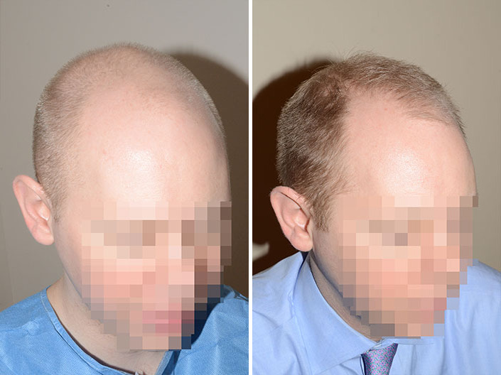 Hair Transplants for Men Before and after in Miami, FL, Paciente 37511