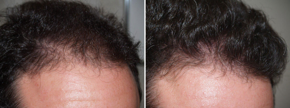 Hair Transplants for Men Before and after in Miami, FL, Paciente 37520