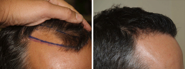 Hair Transplants for Men Before and after in Miami, FL, Paciente 37586