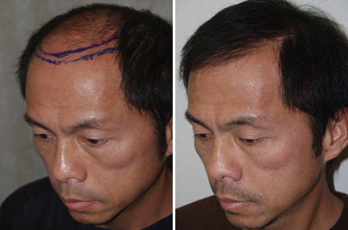 Hair Transplants for Men Before and after in Miami, FL, Paciente 37604