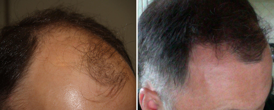 Hair Transplants for Men Before and after in Miami, FL, Paciente 37618