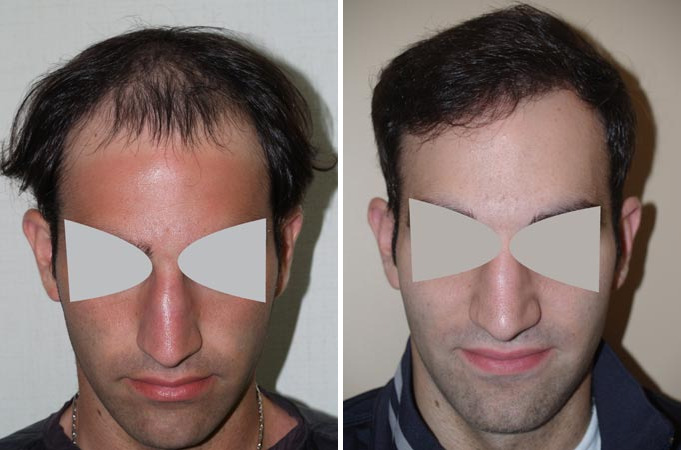 Hair Transplants for Men Before and after in Miami, FL, Paciente 37625