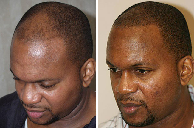 Hair Transplants for Men Before and after in Miami, FL, Paciente 37710