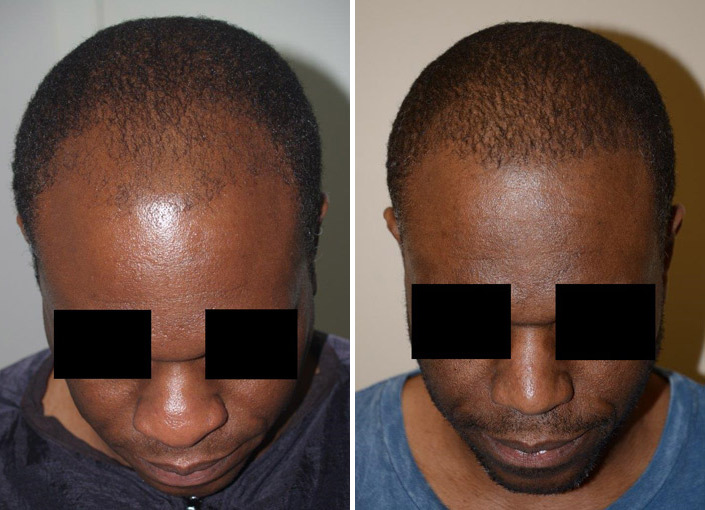 Hair Transplants for Men Before and after in Miami, FL, Paciente 37766