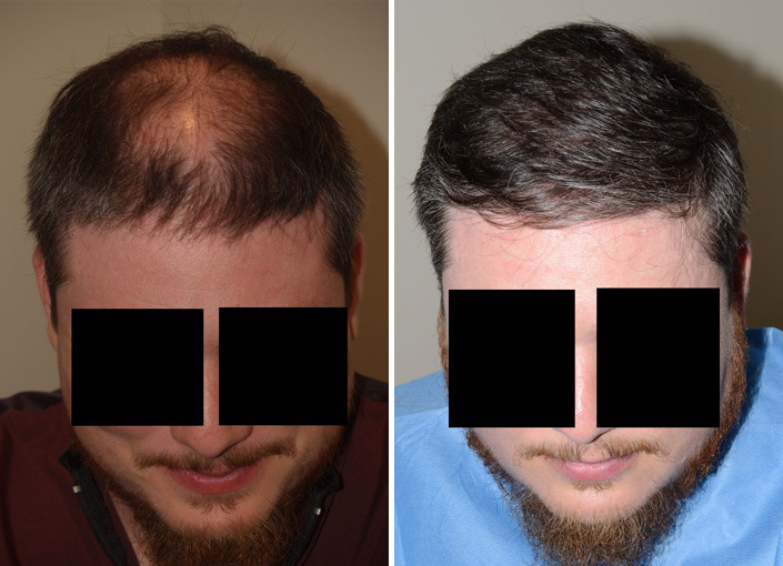 Hair Transplants for Men Before and after in Miami, FL, Paciente 37776