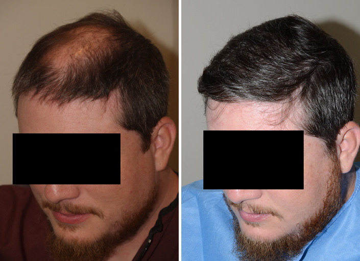 Hair Transplants for Men Before and after in Miami, FL, Paciente 37776