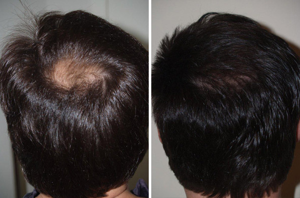 Hair Transplants for Men Before and after in Miami, FL, Paciente 37783