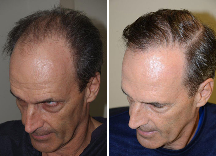 Hair Transplants for Men Before and after in Miami, FL, Paciente 37789