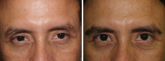 Eyebrow Hair Transplant Before and after in Miami, FL, Paciente 37801