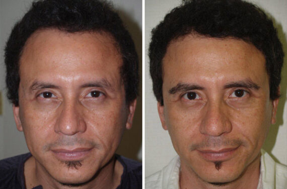 Eyebrow Hair Transplant Before and after in Miami, FL, Paciente 37801