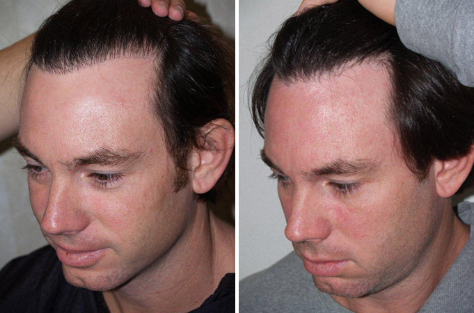 Hair Transplants for Men Before and after in Miami, FL, Paciente 37862