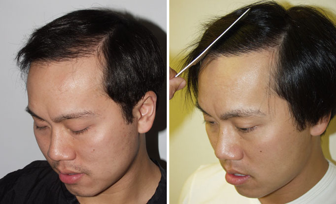 Hair Transplants for Men Before and after in Miami, FL, Paciente 37905