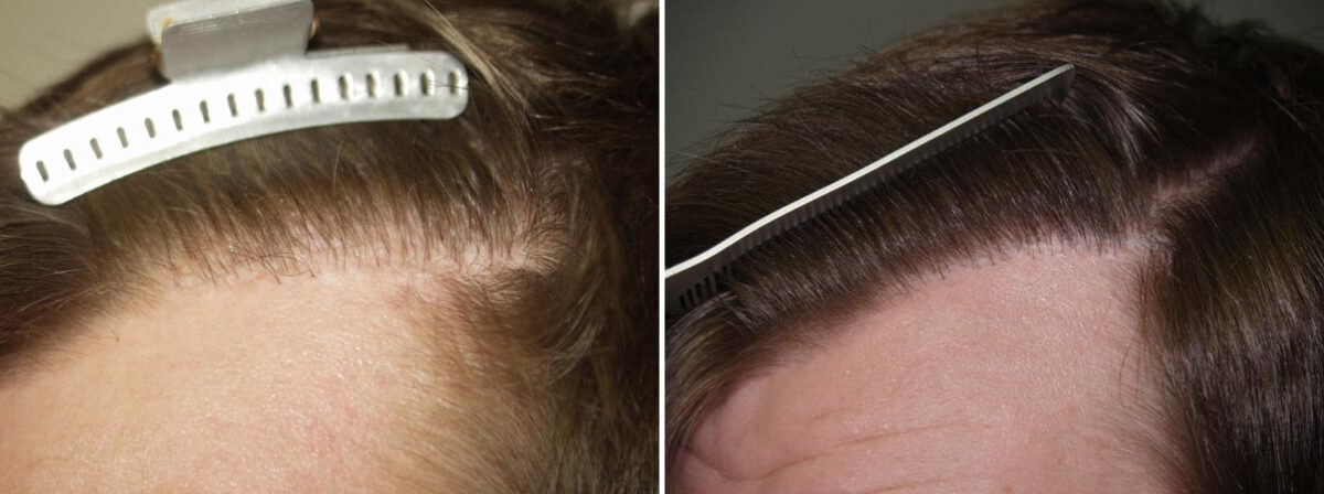 Hair Transplants for Men Before and after in Miami, FL, Paciente 37965