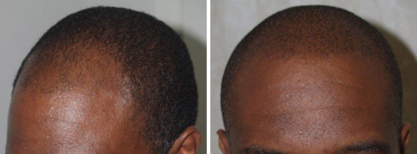 Hair Transplants for Men Before and after in Miami, FL, Paciente 37972