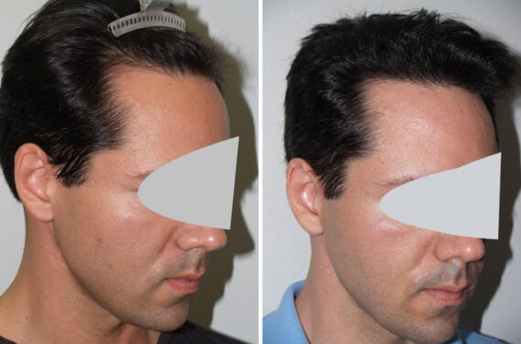 Hair Transplants for Men Before and after in Miami, FL, Paciente 37978