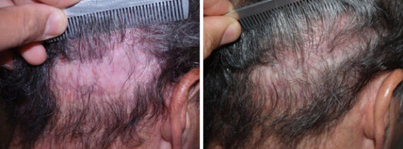 Donor Site Transplant Close Ups Before and after in Miami, FL, Paciente 38034