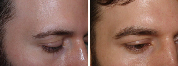 Eyebrow Hair Transplant Before and after in Miami, FL, Paciente 38045