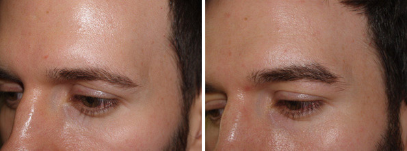 Eyebrow Hair Transplant Before and after in Miami, FL, Paciente 38045