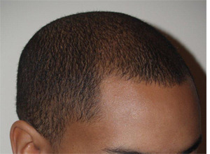 Hair Transplants for Men Before and after in Miami, FL, Paciente 38297