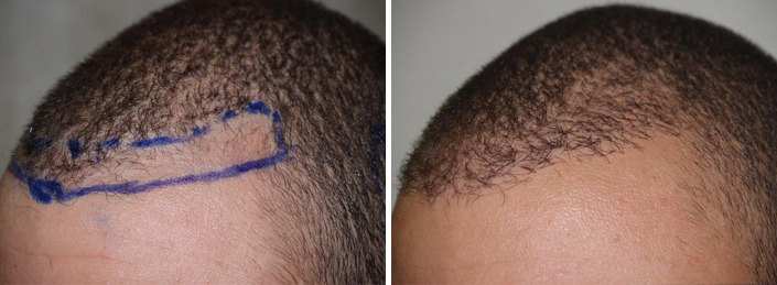 Hair Transplants for Men Before and after in Miami, FL, Paciente 38322