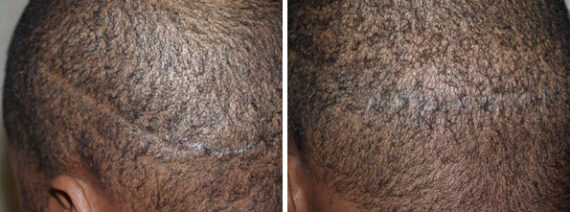 Donor Site Transplant Close Ups Before and after in Miami, FL, Paciente 38371