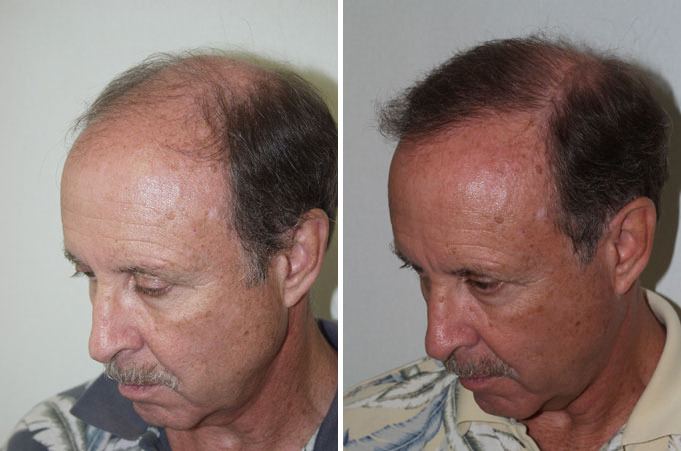 Hair Transplants for Men Before and after in Miami, FL, Paciente 38661