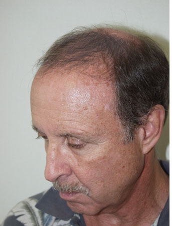 Hair Transplants for Men Before and after in Miami, FL, Paciente 38661